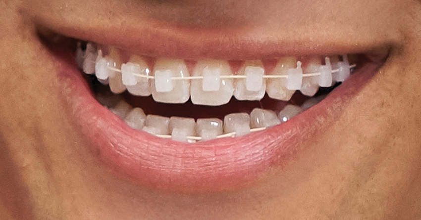 Niềng răng sứ "tàng hình" ứng dụng công nghệ vì nụ cười đẹp tự nhiên - 0